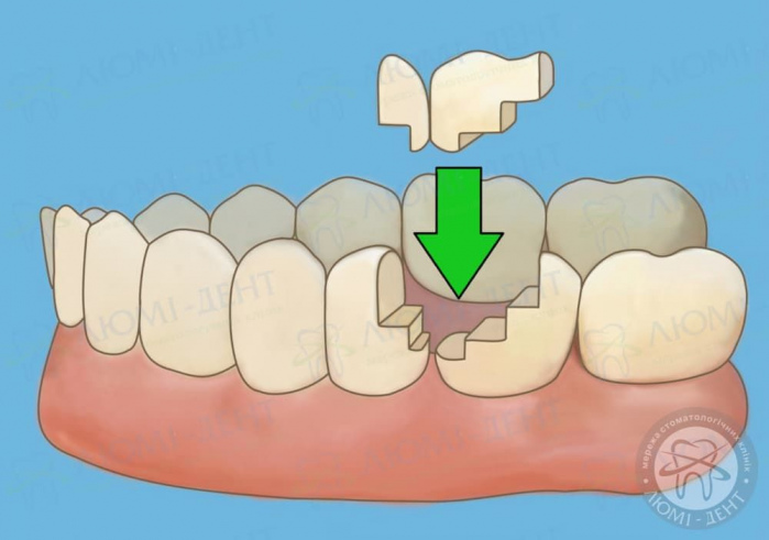 вкладки на зуби фото ЛюміДент