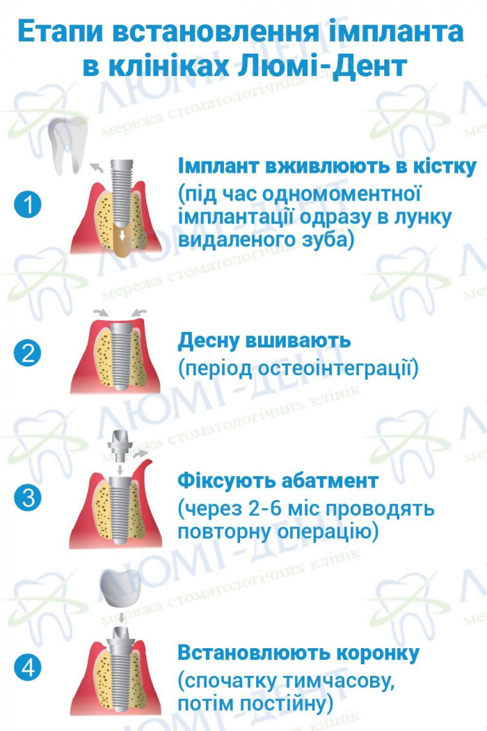 Зубні імпланти українського виробництва Фото ЛюміДент