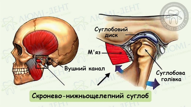 Дисфункція скронево-нижньощелепного суглоба фото Люмі-Дент