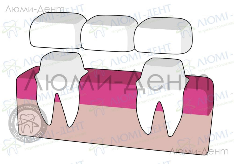 Мост на зубы фото Люмидент