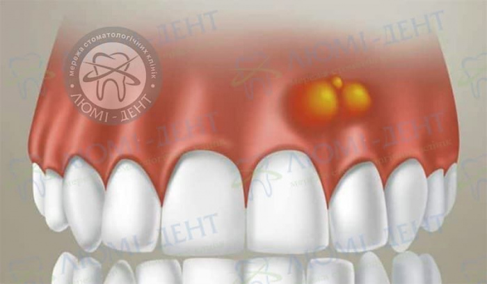 Свищ в роті фото ЛюміДент