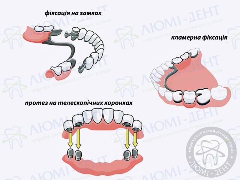 знімне протезування фото ЛюміДент