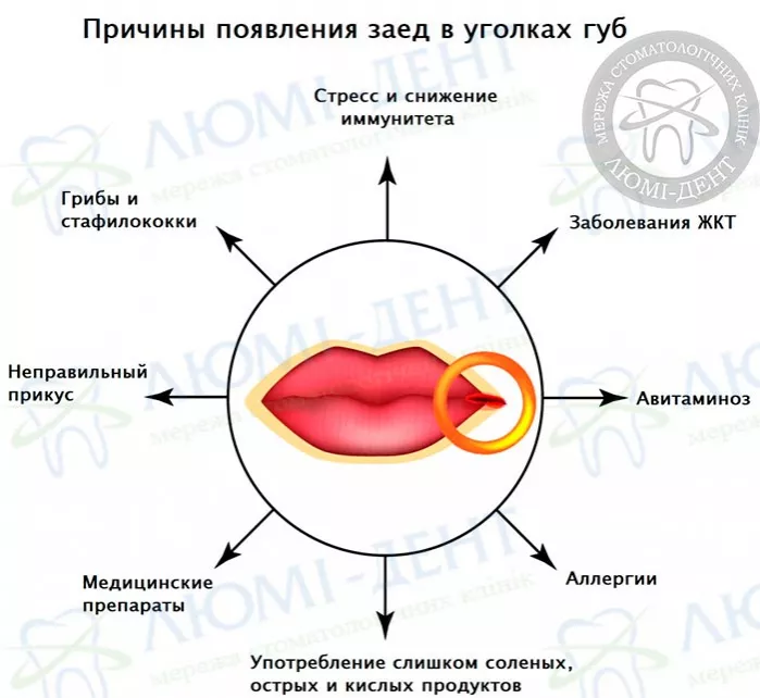 Причины появления заед в уголках губ Заеды на губах фото ЛюмиДент