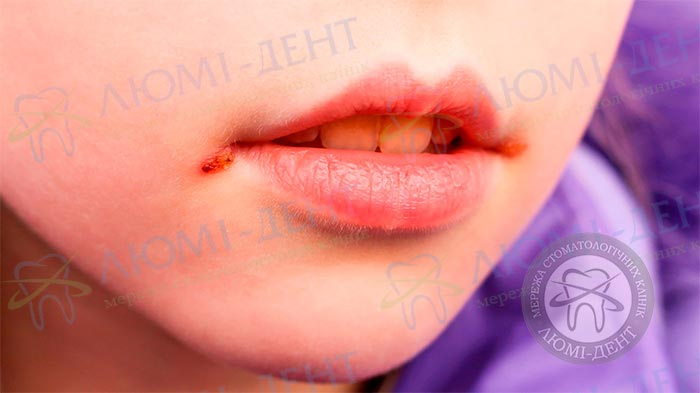 Причина появления морщин вокруг губ