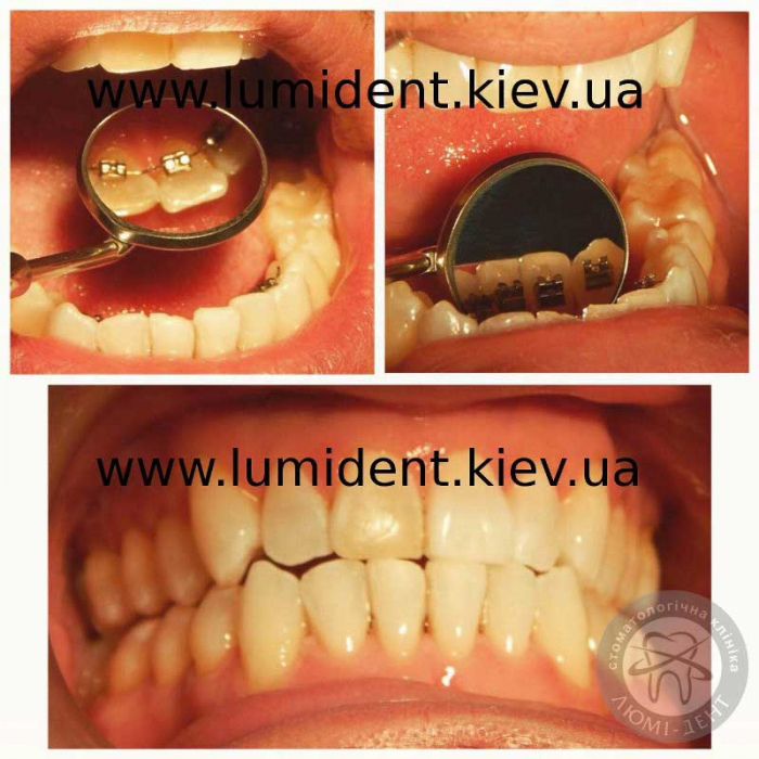 Lingual braces for teeth photo Lumi-Dent