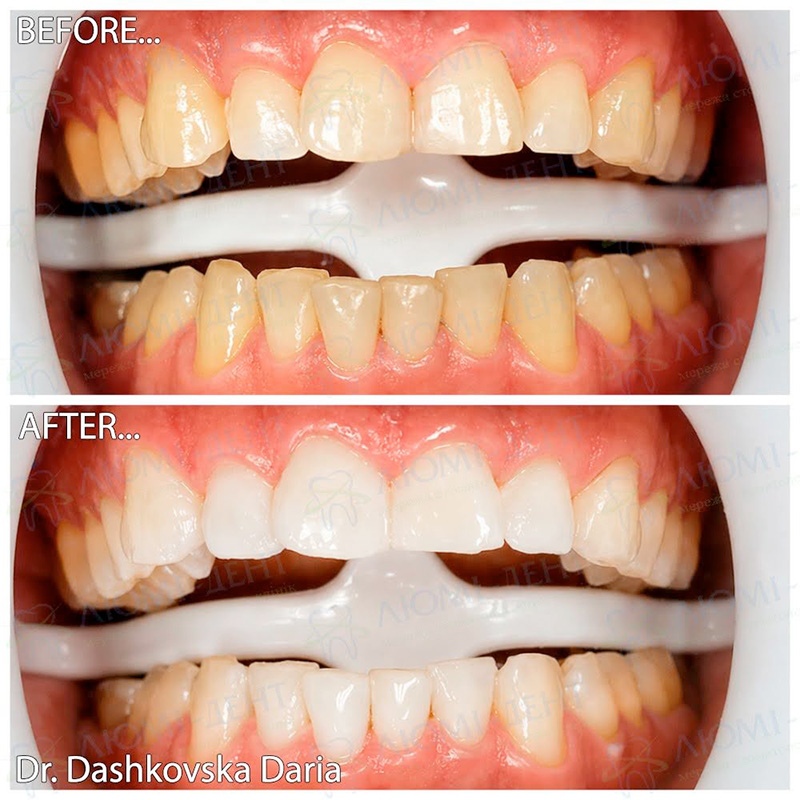 Отбеливание зубов системой Magic Smile Отбеливание зубов системой Magic Smile при дисколорите зубов