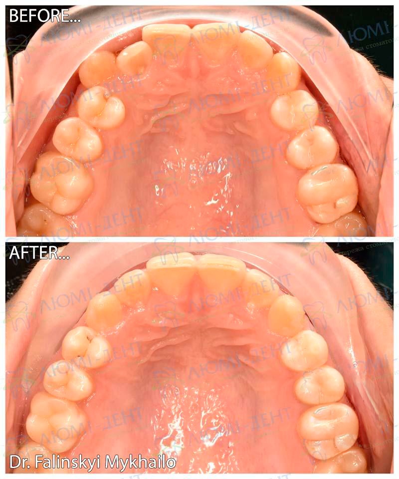 Пример исправления прикуса элайнерами Invisalign Клинический случай Фалинский Михаил Михайлович