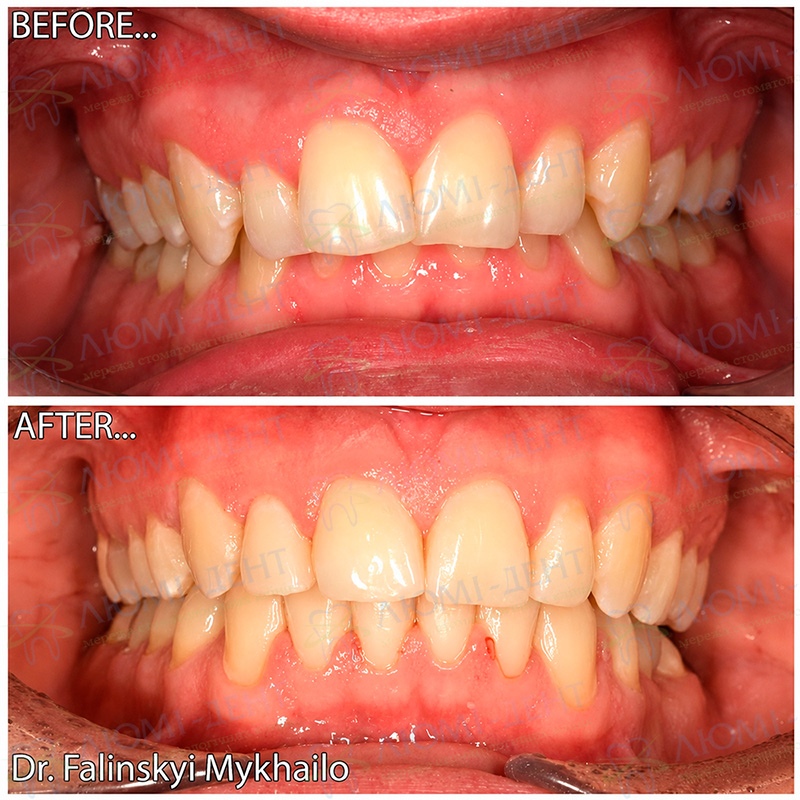 Исправления прикуса фото до и после Пациент врача стоматолога Фалинский Михаил Михайлович