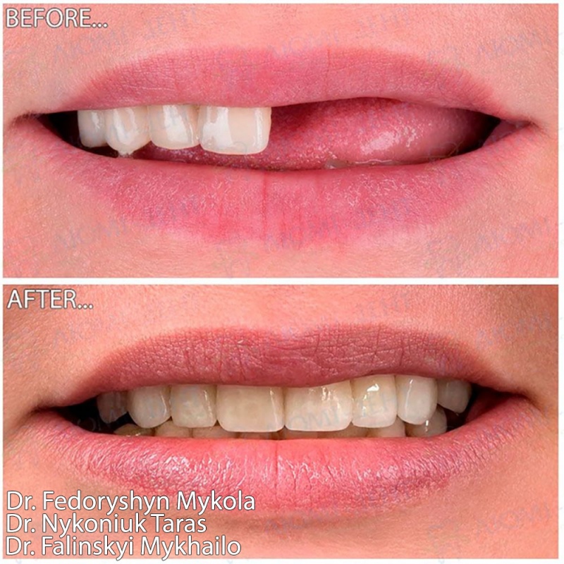 Імплантація All-on-6 на верхній щелепі Straumann Імплантація All-on-6 на верхній щелепі з протезуванням Straumann