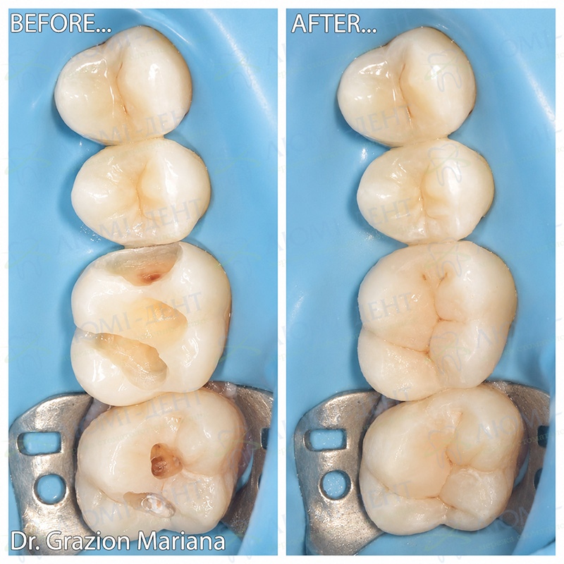 Фото зубів до та після реставрації вторинного та пришийкового карієсу Фото зубів до та після реставрації вторинного та пришийкового карієсу