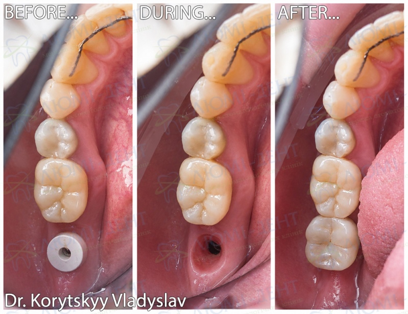 Імплантація та протезування зуба 4.7 постійною коронкою з діоксиду цирконію, лікар Корицький Владислав Імплантація та протезування зуба 4.7 постійною коронкою з діоксиду цирконію Корицький Владислав