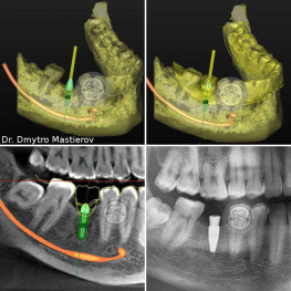 Example of the work of the surgeon-implantologist Masterov DV Lumi-Dent