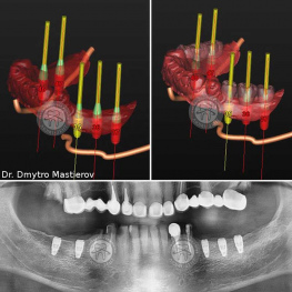 Рентген и 3D-модель зубов Люмидент