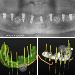 Dental implantation Kiev Ukraine Lumi-Dent