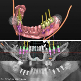 Designing of implantation