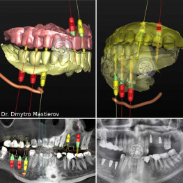 Implantation strategy