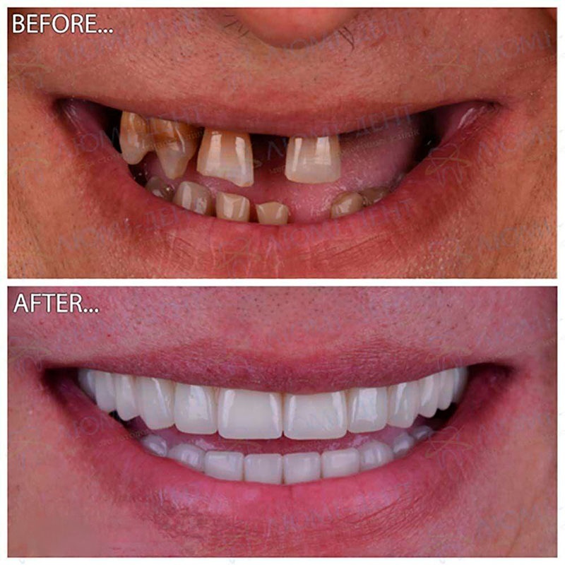 Photo-work-before-and-after-Lumi-Dent