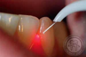лазерная стоматология
