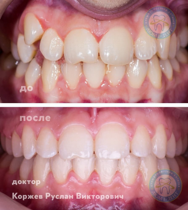 Кривые зубы у взрослых исправление фото Киев Люми-Дент