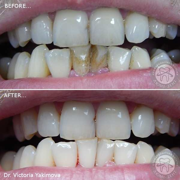 Teeth cleaning before after Lumi-Dent