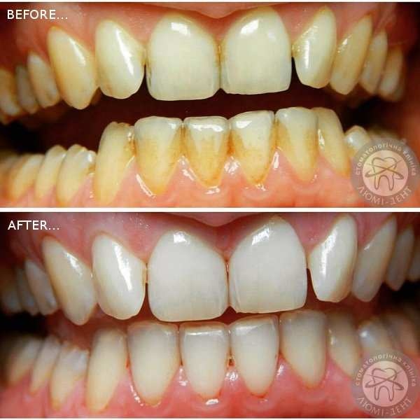 До та після чистки зубів Air-Flow фото Люми-Дент