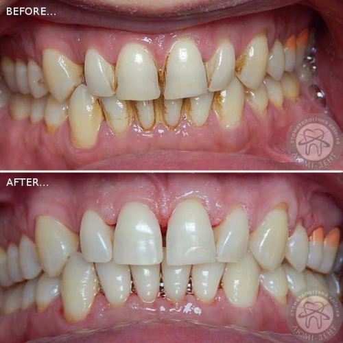 Гигиеническая чистка зубов у стоматолога фото Киев Люми-Дент