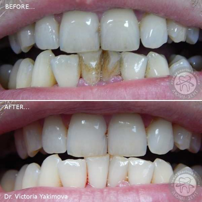 Удаление зубного камня ультразвуком фото Люми-Дент