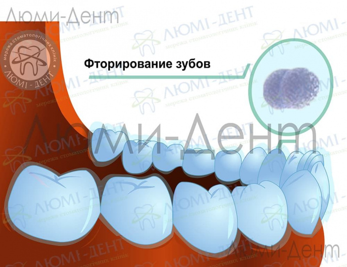 Реминерализация зубов