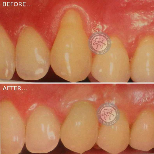 Treatment of periodontal disease of gum inflammation Kiev LumiDent