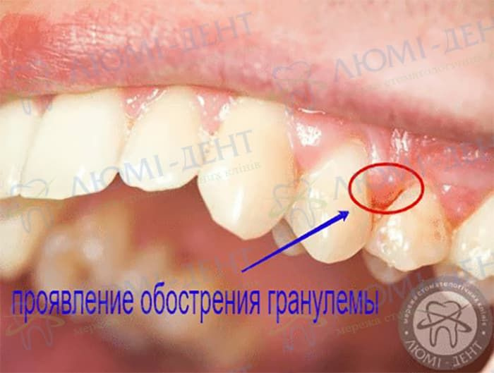 Что такое гранулема зуба фото Люми-Дент