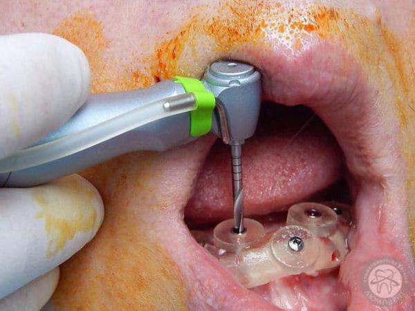 Імплантація зубів Люмі-Дент