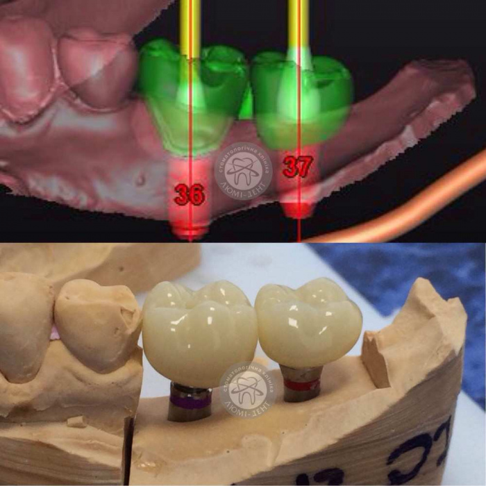 Зубные импланты зубов за один день имплантация Люми-Дент 