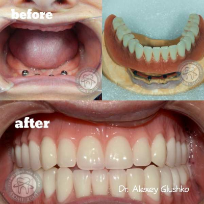 dental prosthesis