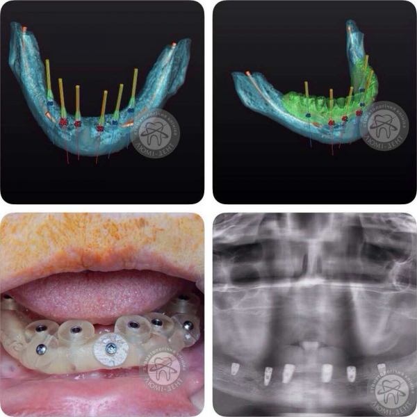 Имплантация зубов видео фото Люми-Дент 