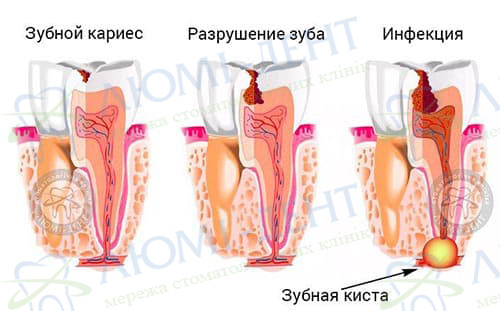Зубная киста лечение фото Киев Люми-Дент