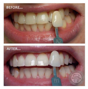 отбеливание зубов фото, до и после Люмидент