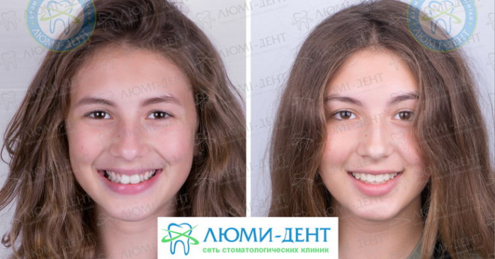 Фото лица до и после брекетов Люмидент