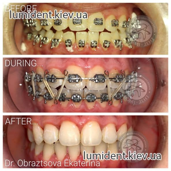 Braces for teeth photo system Kiev Lumi-Dent