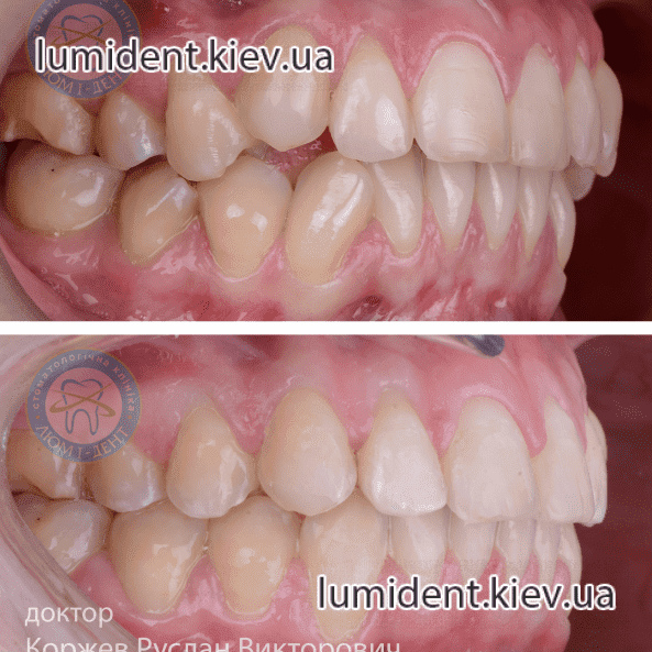 Correct bite of teeth before and after photo Lumi-Dent