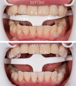 отбеливание зубов киев, фото, до и после