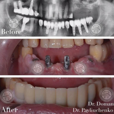 dental prosthesis