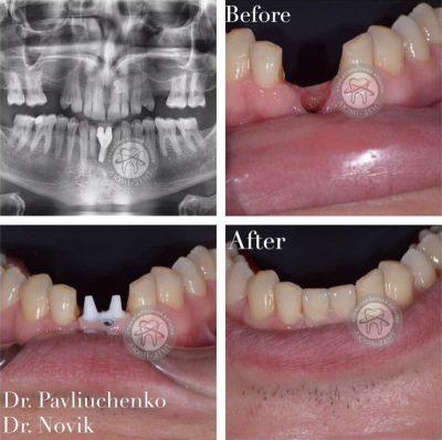 dental prosthesis