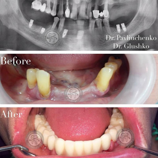 Зубные импланты за и против фото Люми-Дент 