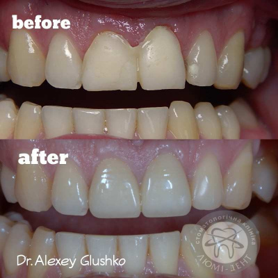 dental prosthesis