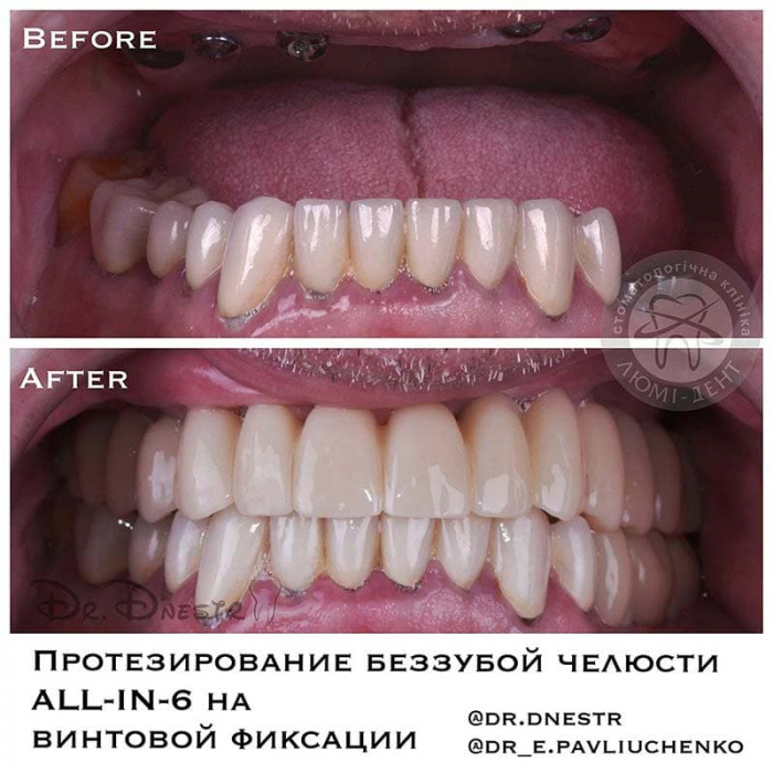 Dental implantation photos before and after Lumi-Dent