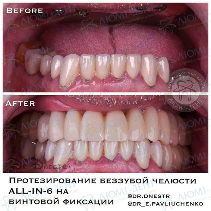 Имплантация зубов фото до и после Люми-Дент