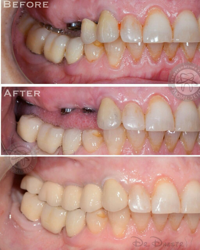 Prosthetics with dental crowns photo Lumi-Dent