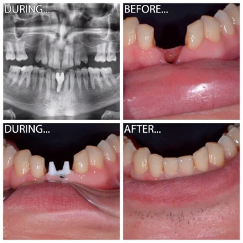 повне протезування зубів фото робіт 