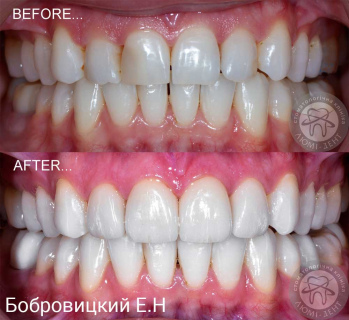 протезування зубів київ, фото, до та після