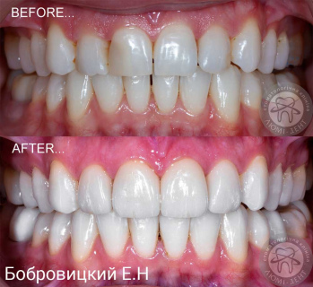 dental prosthesis
